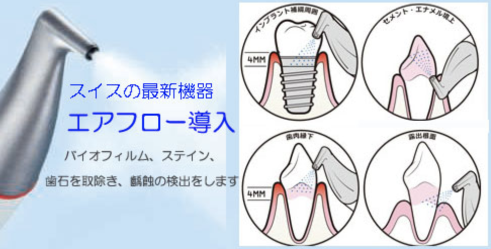 インプラント、エアフロー、エールガイド