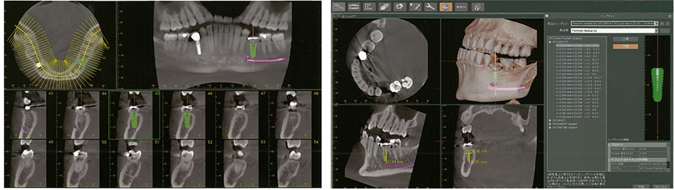 インプラント、歯科用CT、エールガイド